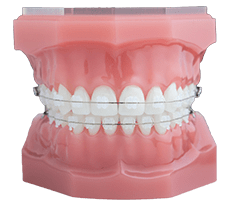 clear braces on model