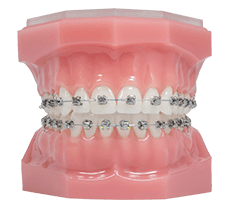 metal braces on model