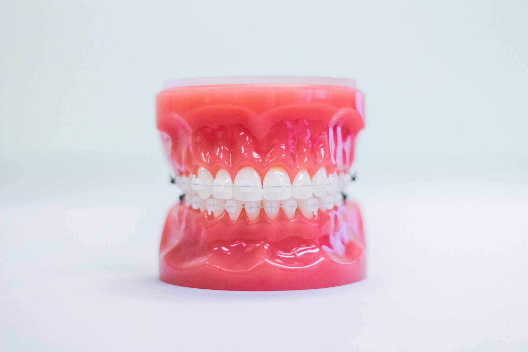 Clear braces shown on a dental model for orthodontic treatment in Glendora CA
