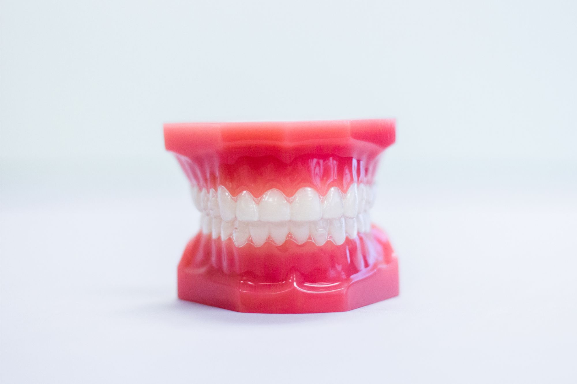 Invisalign aligners displayed on a dental model for orthodontic treatment in Glendora CA