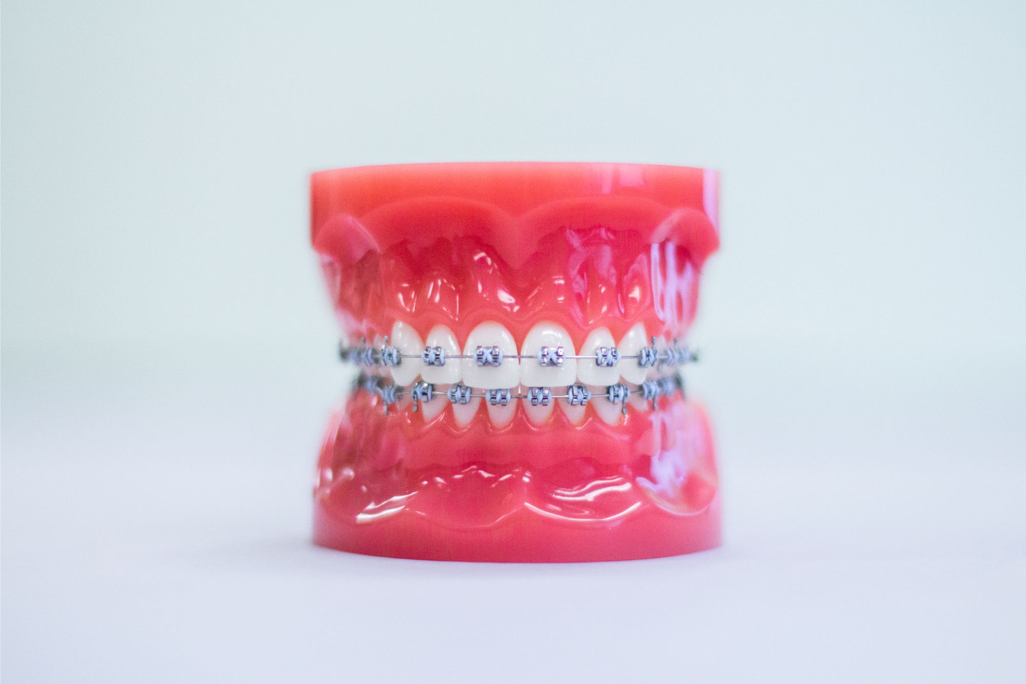 Metal braces displayed on a dental model for orthodontic treatment in Glendora CA
