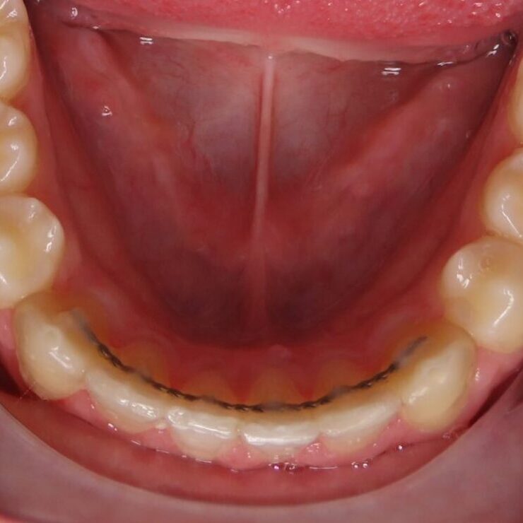 Fixed lower bonded retainer shown on teeth after orthodontic treatment in Glendora CA